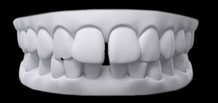 Space between teeth