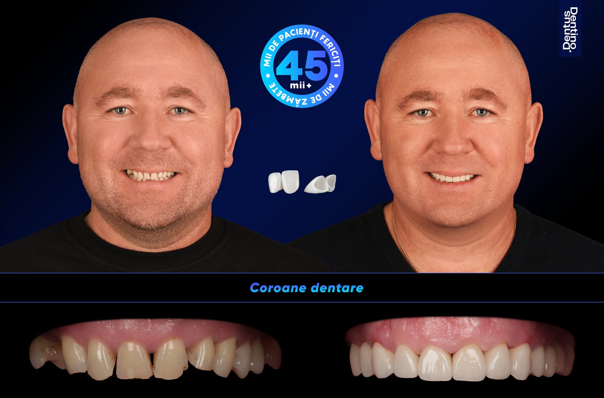 coroane dentare chisinau