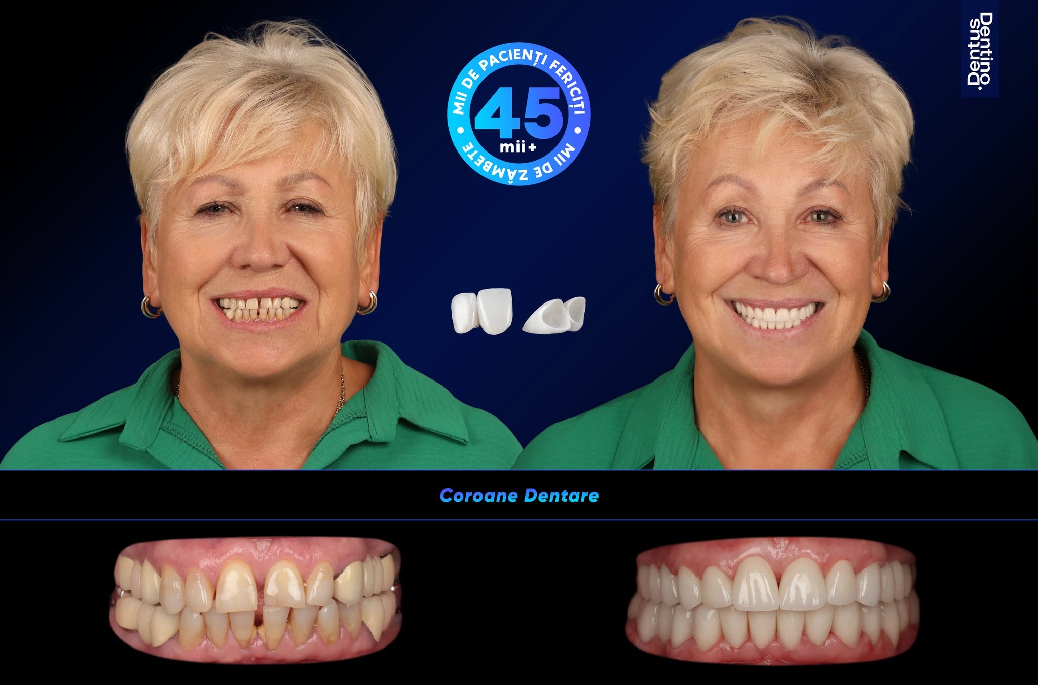 coroane dentare in 5 zile